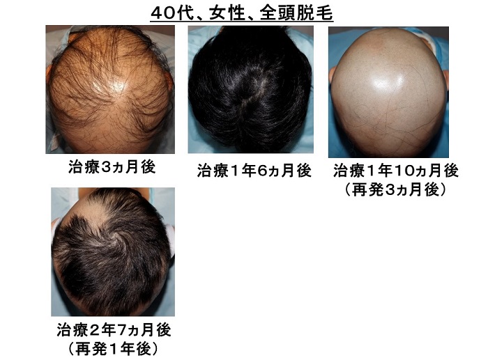 円形脱毛症　病院